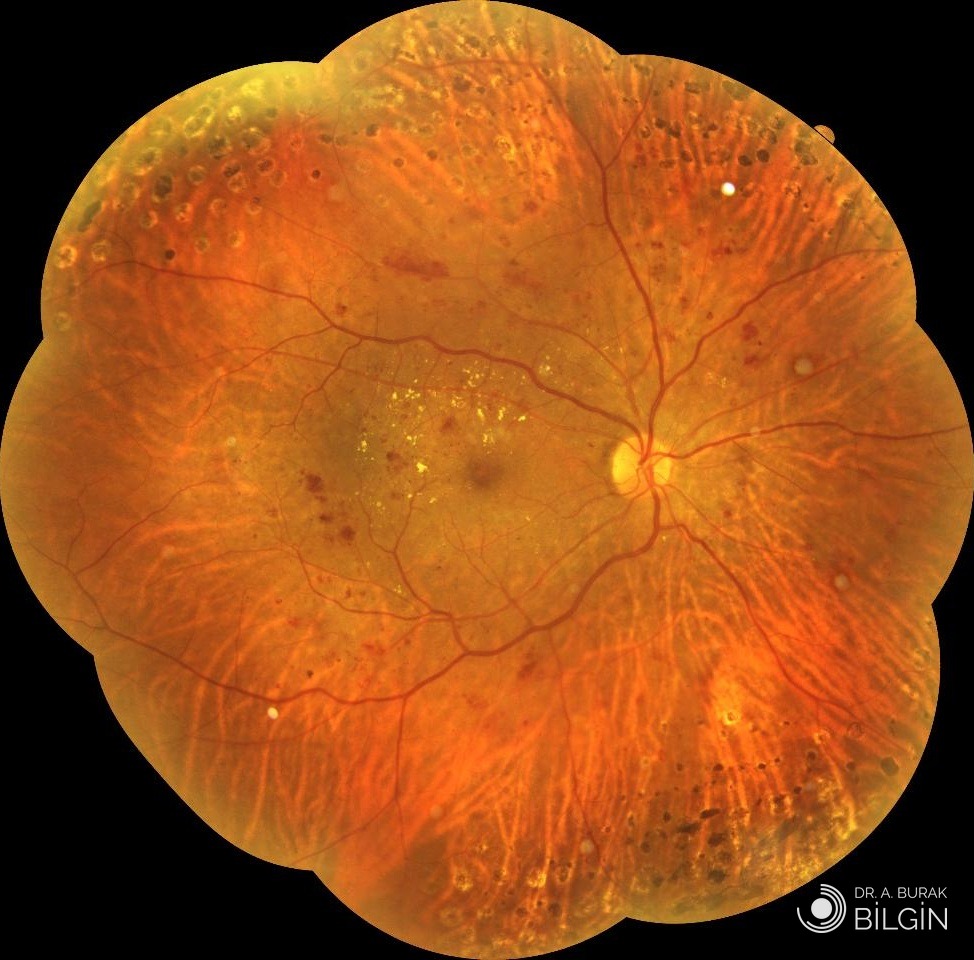 Şeker hastalığına bağlı retinopatisi olan bir gözün geniş açılı fundus fotoğrafı. Retinanın çevresinde daha önce yapılmış lazer tedavisinin yuvarlak izleri, sarı nokta çevresinde ise kanamalar ve sert eksüda denen sarı birikintiler görülüyor. Prof. Dr. A. Burak Bilgin arşivi.