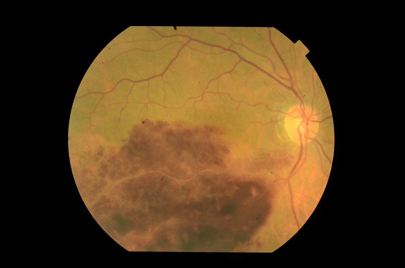 Renkli fundus fotoğrafı — retinanın alt yarısını kaplayan yaygın retina içi kanama