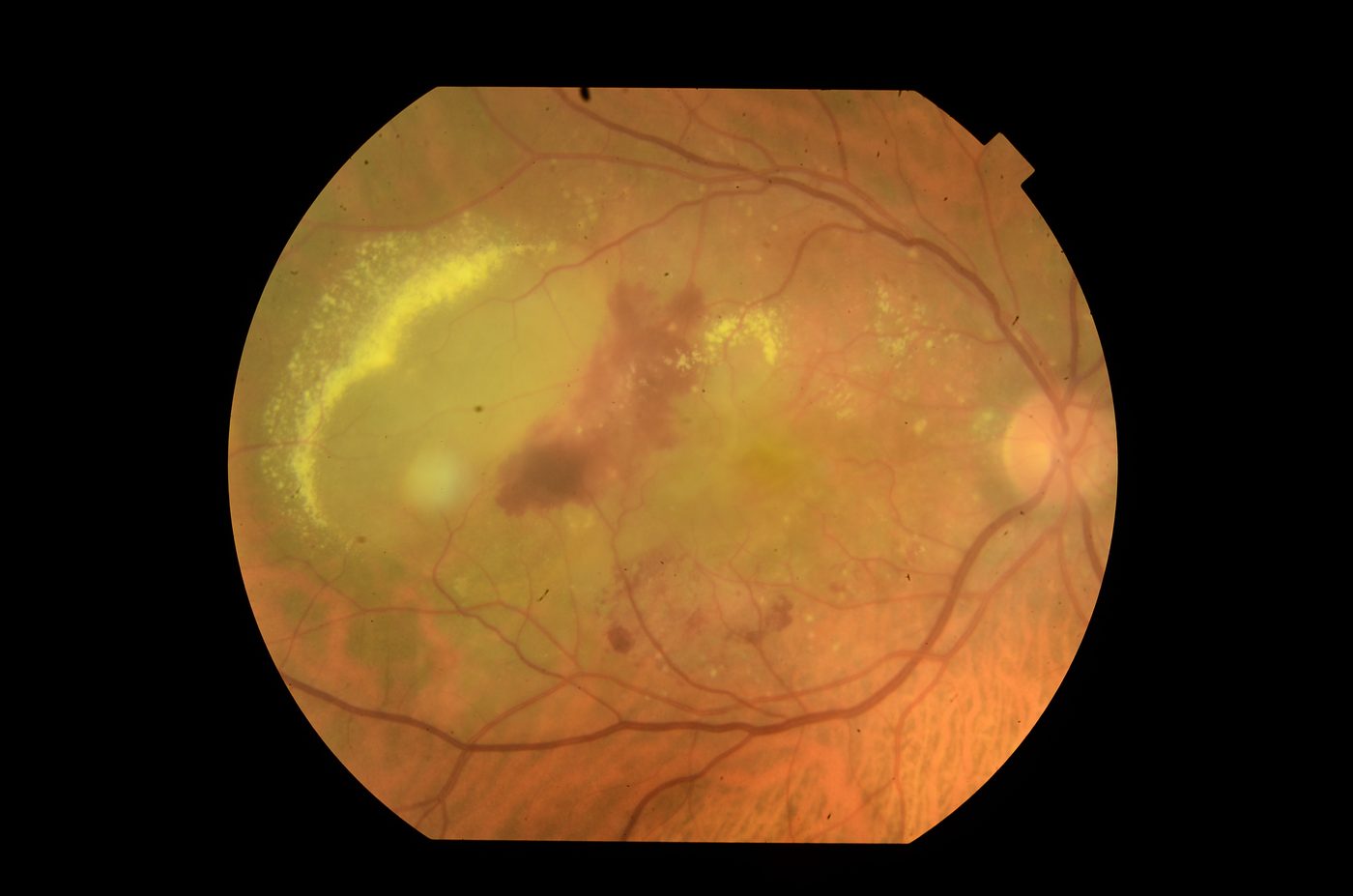 Renkli fundus fotoğrafı — makülada sert eksüda birikimi ve retina kanaması