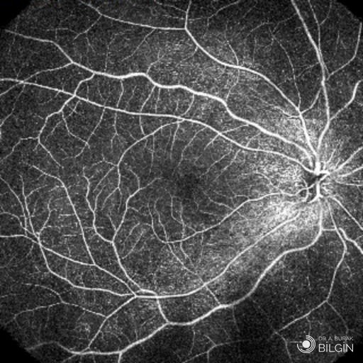 İlaçsız anjiyografi ile çıkarılmış retina damar haritası. Görüntü, damarların içindeki kan akımı algılanarak elde edilir; hastaya boya verilmemiştir. Sağda damarların toplandığı yer görme sinirinin başıdır. Prof. Dr. A. Burak Bilgin arşivi.