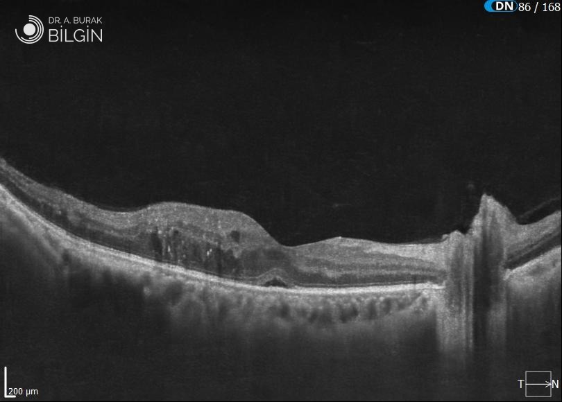 Şeker hastalığına bağlı sarı nokta ödeminin OCT görüntüsü. Retina kalınlaşmış; retina içinde sarı nokta altında sıvı dolu boşluklar oluşmuş; sarı noktanın merkezindeki çukur sığlaşmış. Prof. Dr. A. Burak Bilgin arşivi.